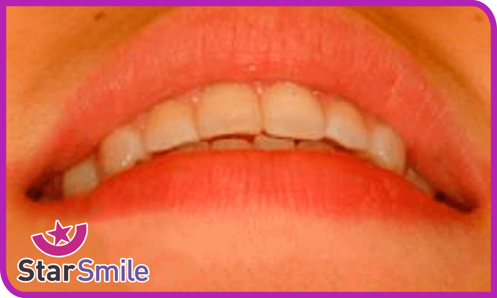 Поворот центрального зуба после