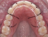 Съемные ретейнеры в ортодонтическом лечении