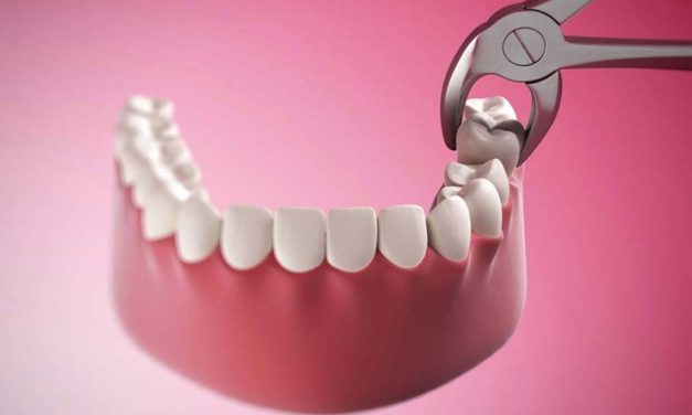 Болят зубы мудрости — лечить или удалять?