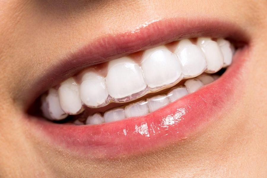 Исправление прикуса без брекетов: незаметные элайнеры для зубов