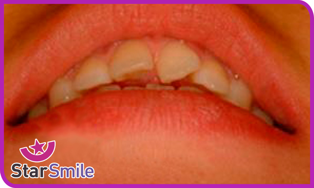 Поворот центрального зуба до