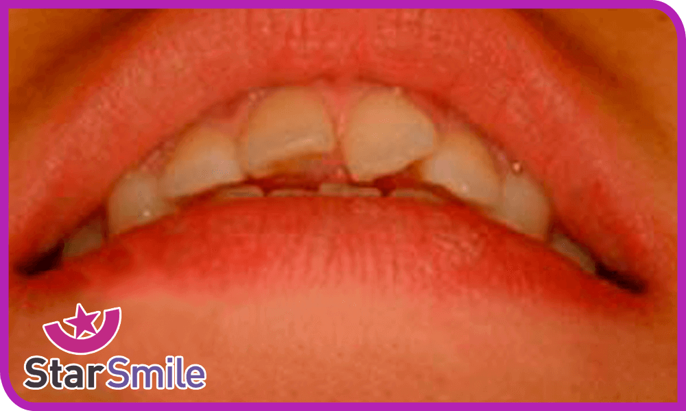 Поворот центрального зуба до