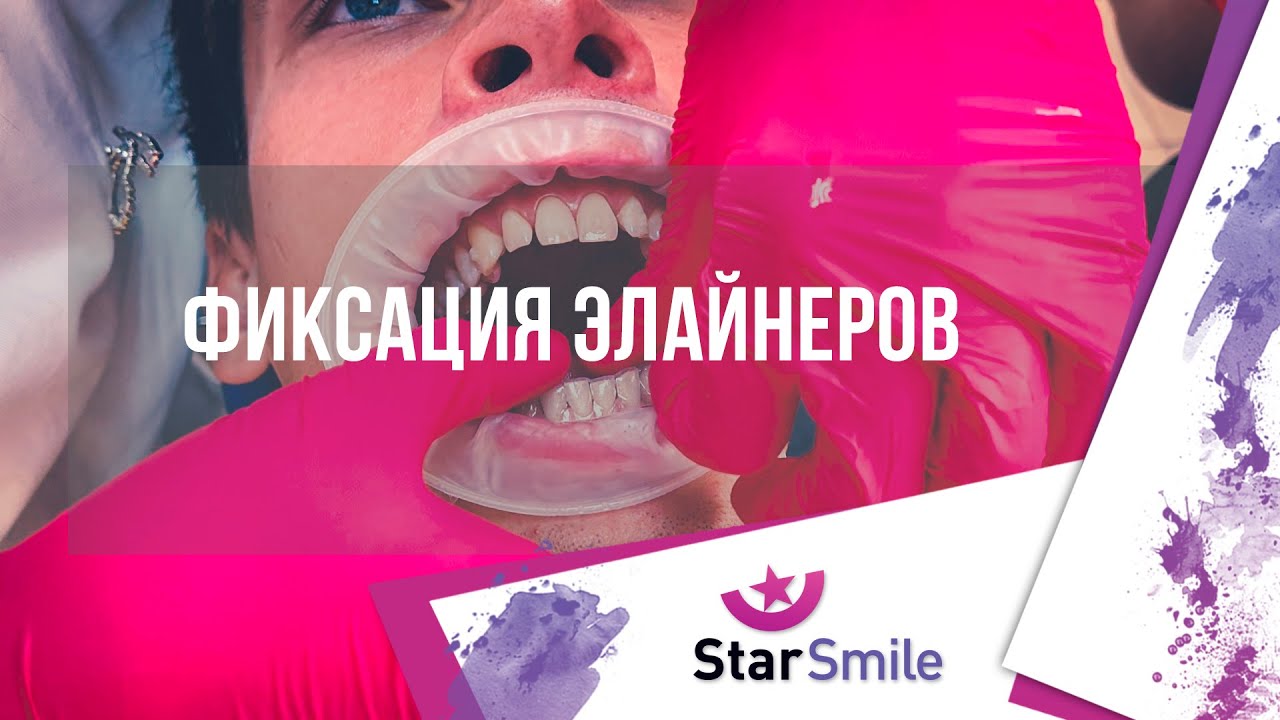 Фиксация элайнеров на зубы. Элайнеры Star Smile.