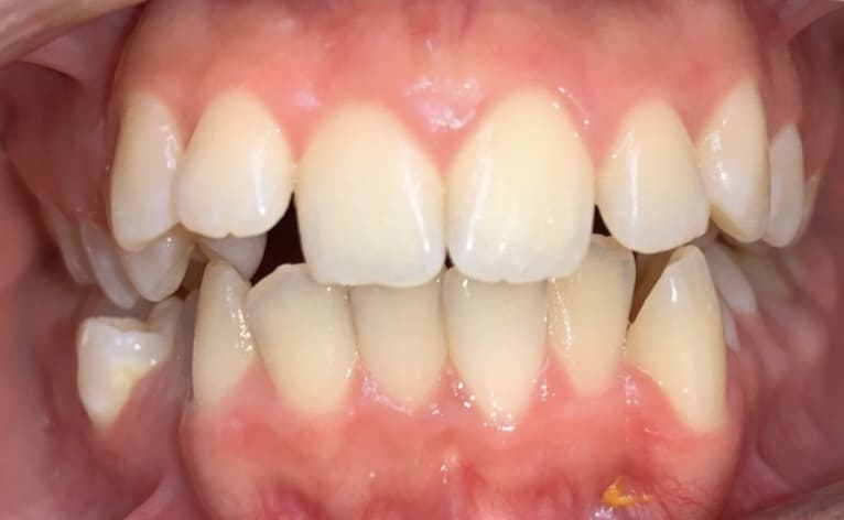 Очень неровные зубы: как исправить прикус в таком случае?