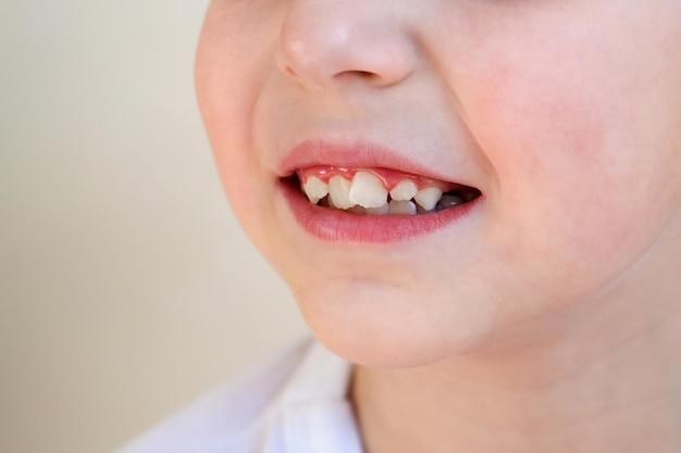 Скученность зубов у ребенка
