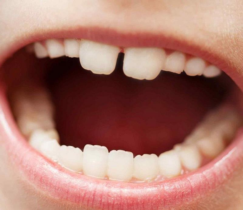 Ребристые зубы у ребенка
