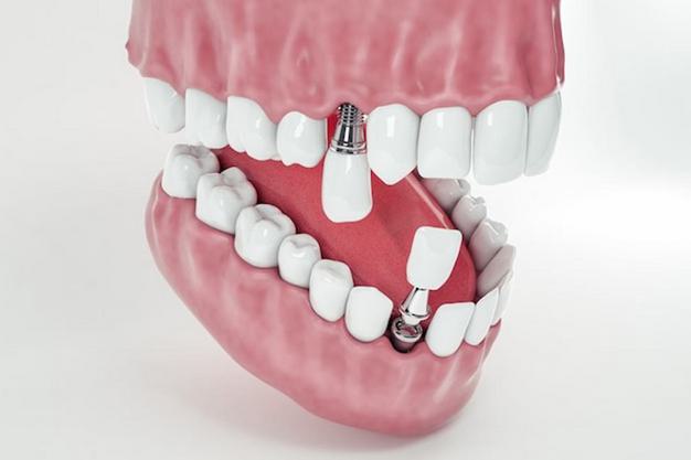 Имплант может работать опорой для ортодонтической конструкции