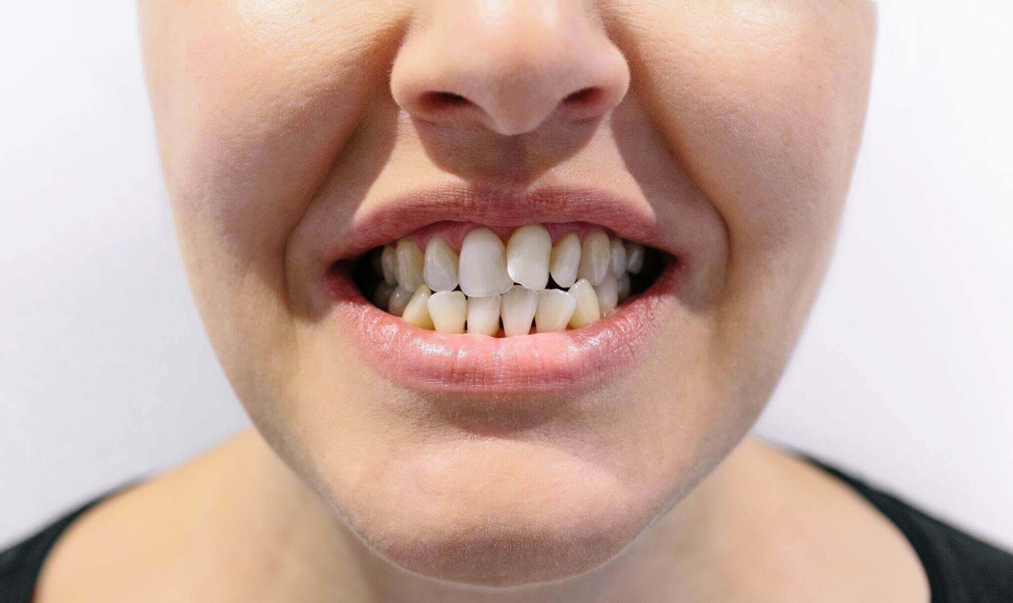 Женский рот со скученностью зубов
