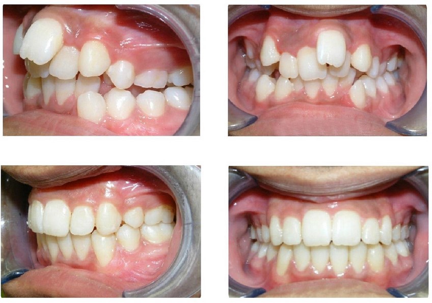 Зубы до и после брекетов