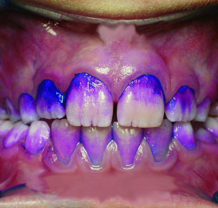 На зубы нанесен состав, который окрашивает налет