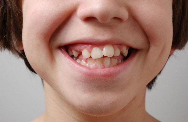 Неровные зубы у ребенка