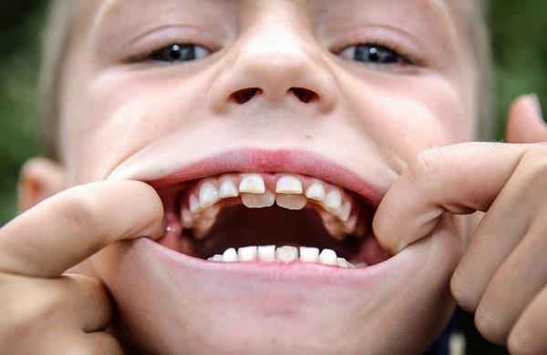 Зубы у ребенка в два ряда