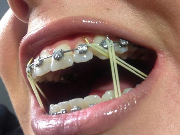 Ортодонтические тяги