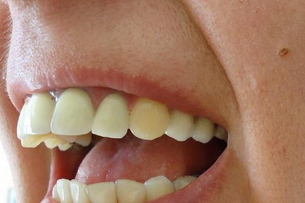 Протрузия верхних зубов