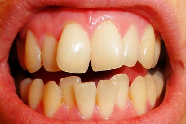 Ротированные зубы