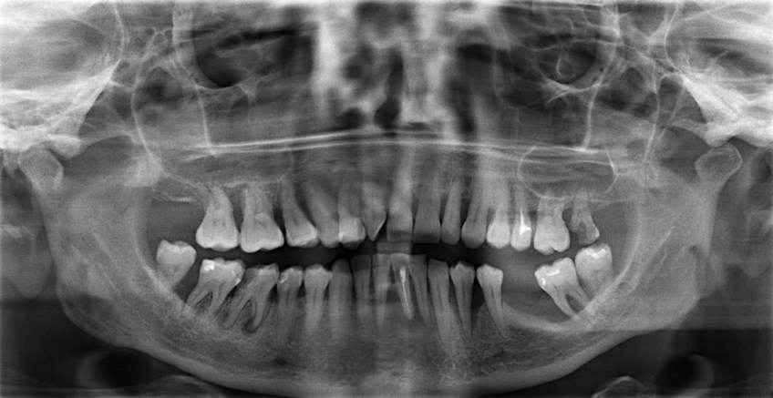 Атрофия кости челюсти