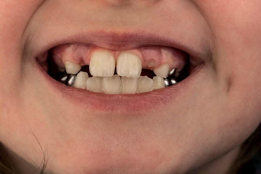 Коронки на молочных зубах