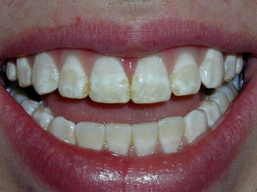 Флюороз на зубах