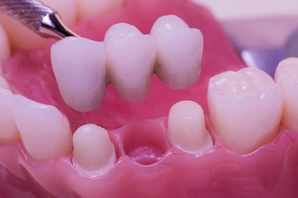 Коронки зубов