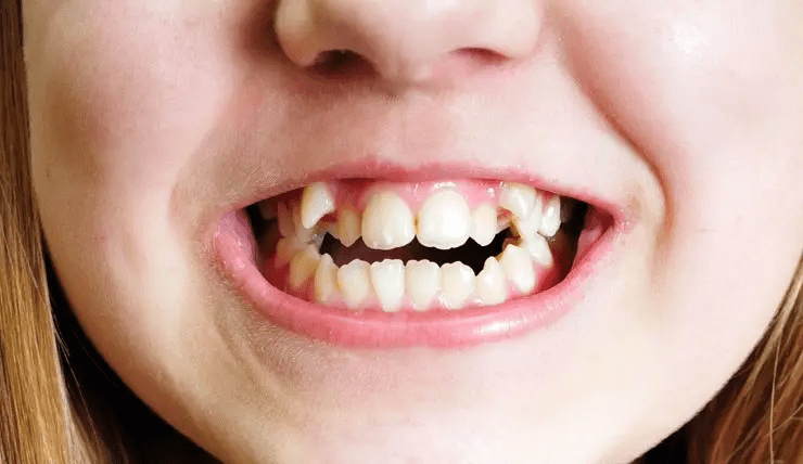 Кривые молочные зубы