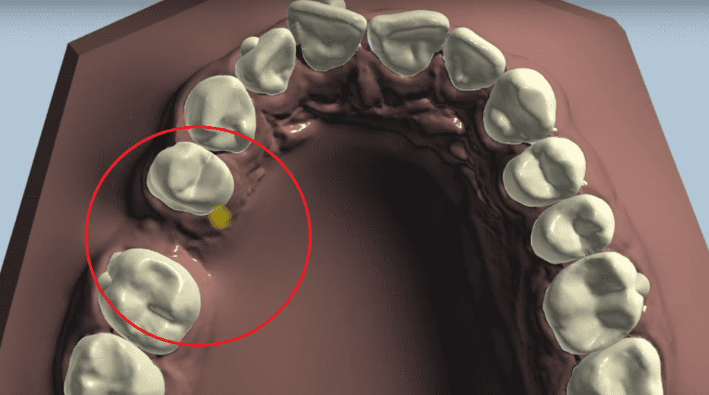 У пациента прозвучал вопрос на предмет отсутствующего зуба на верхней челюсти с правой стороны, зуб номер 5 отсутствует достаточно давно. Хочет поставить имплантат с коронкой