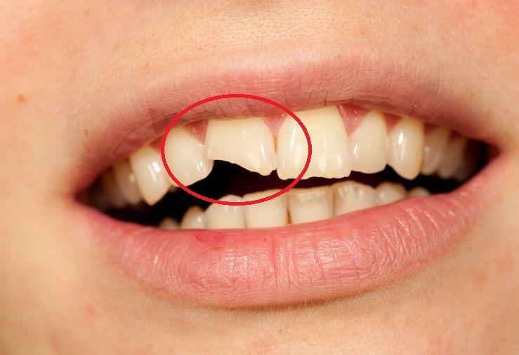 Зуб попросту ломается, но при этом нерв не задет, тогда требуется восстановление твердой ткани зуба