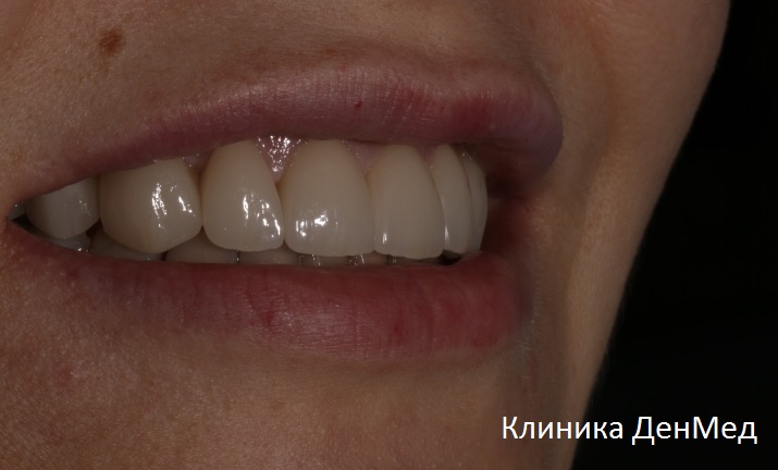 Виниры на зубы: повторная примерка прошла успешно
