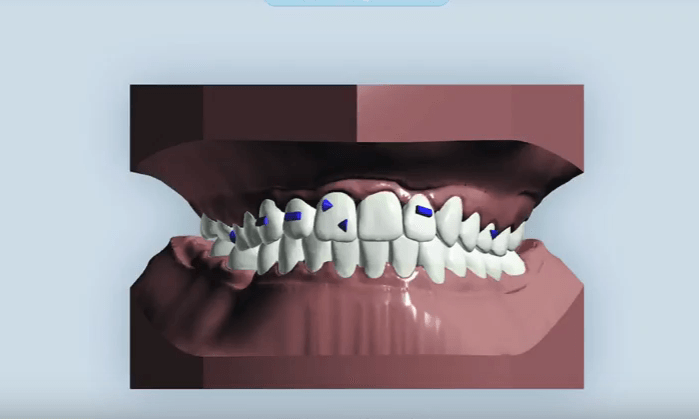 виртуальный сетап позволяет пациенту посмотреть, как передвигаются зубы на каждом этапе лечения. И в конечно итоге лечения зубы становятся в ровный красивый ряд. Красивая улыбка пациенту обеспечена