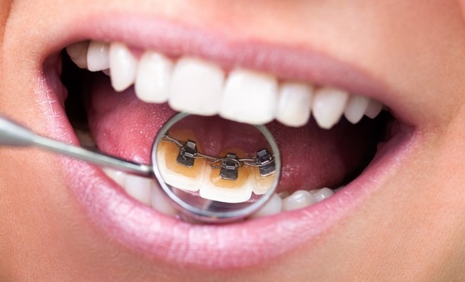 Лингвальные брекеты - как вариант исправления скученности зубов нижней челюсти и выпрямления клыков