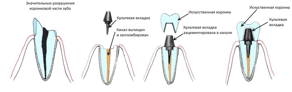 При сильном разрушении коронки зуба используются штифтовая вкладка или коронка