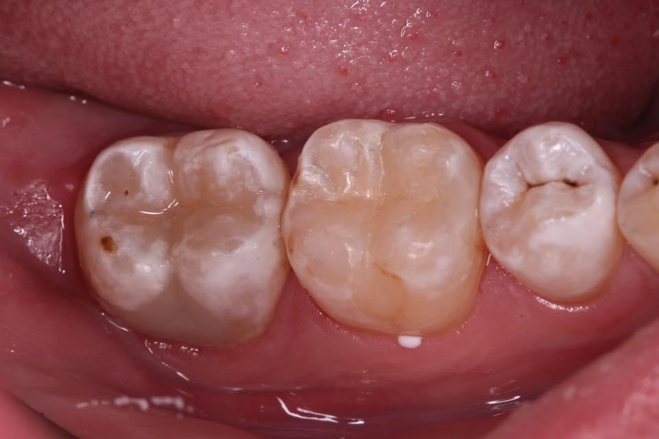 Кариес возникает вследствие разрушения эмали зубов