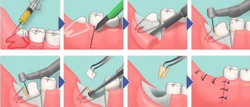 зубы мудрости чаще подвержены возникновению кариозных процессов