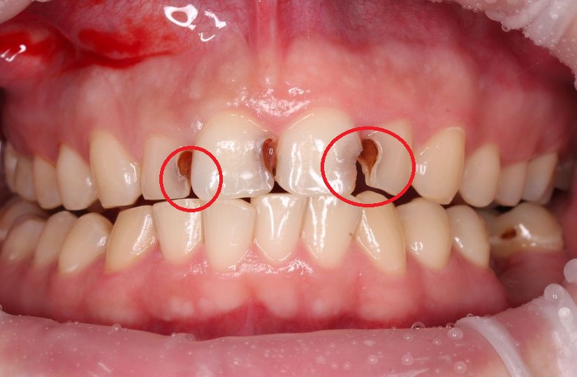 Кариес на боковой поверхности центрального зуба с разрушением режущего края