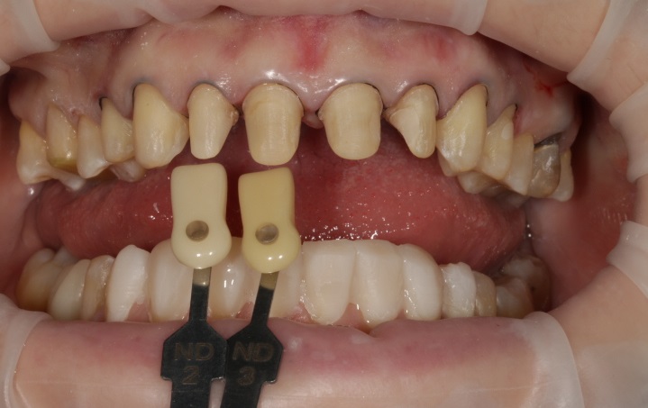Определение цвета исходного зуба. На фото мы видим маркеры, необходимые определения подлежащих структур под керамическую реставрацию
