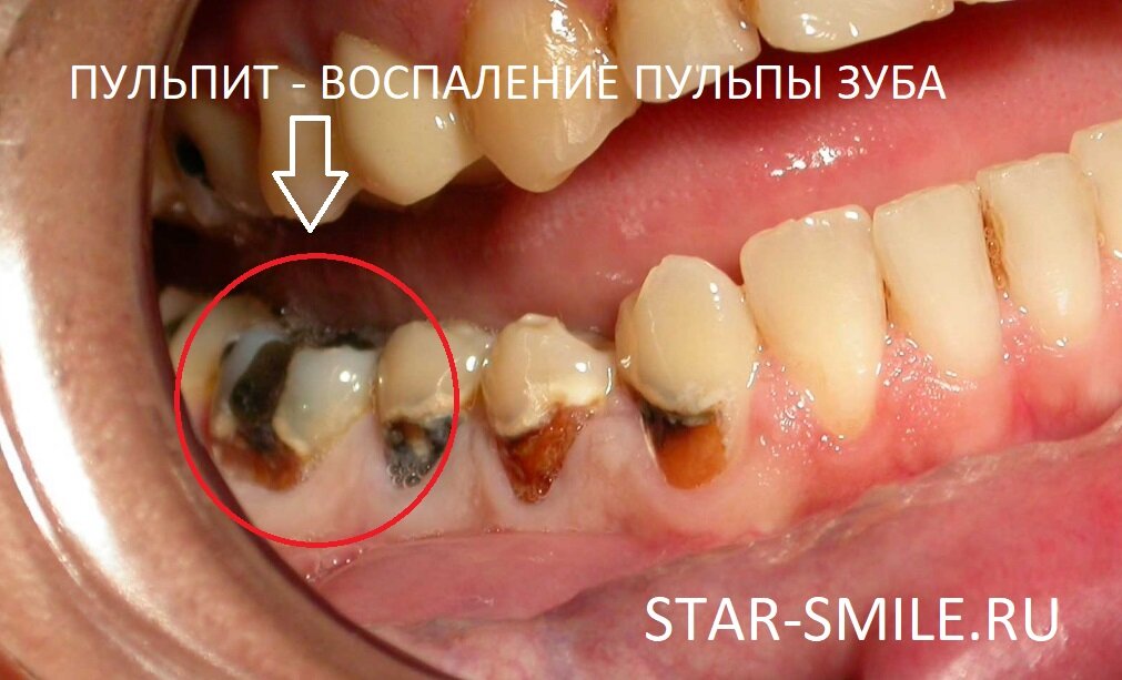Пульпит – это воспаление пульпы зуба, хотя в народе принято называть это воспалением нерва зуба