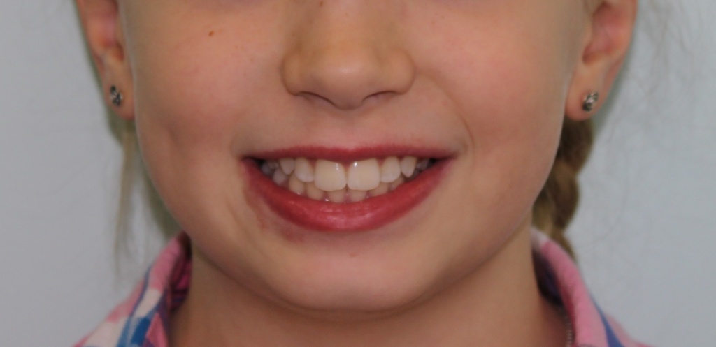 Результат успешного лечения открытого прикуса у ребенка - на лицо. Лечение заняло 3 года и 1 год наблюдение. Сейчас девочке 11 лет. Красивая улыбка
