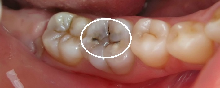 Третья стадия или средний кариес внешне выглядит как темное пятно на зубе