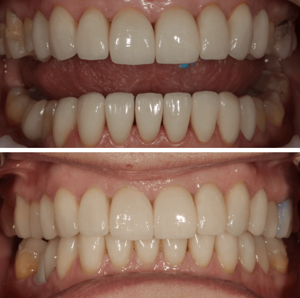 Этот этап и самый приятный, наша пациентка видит и чувствует новые зубы у себя во рту