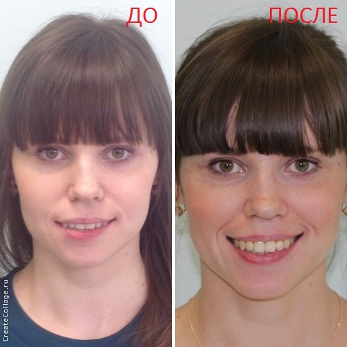 До и после лечения прикуса на элайнерах. Разница в качестве улыбки - очевидна
