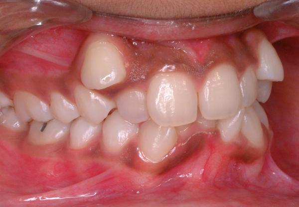четвертая причина кривых зубов - недостаточное внимание скорее со стороны родителей в период смены зубов