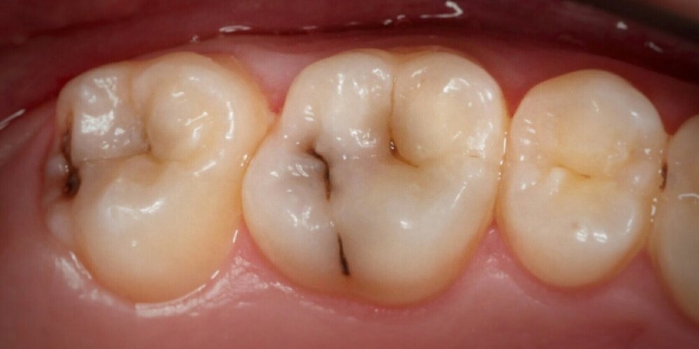 Кариес - один из основных факторов разрушения зубов
