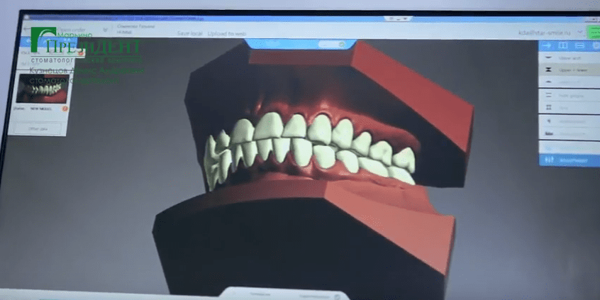 3D моделирование выравнивания зубов происходит еще ДО начала лечения пациента