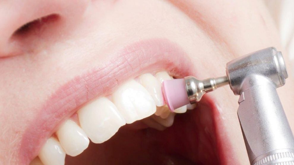 Professionalnaya chistka zubov dostupna v kazhdoy klinike