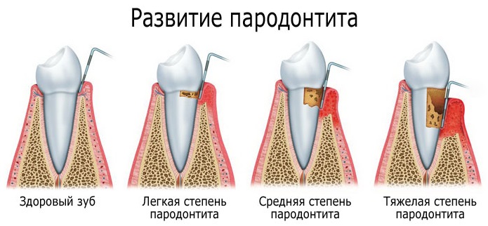 Движение зубов при пародонтите