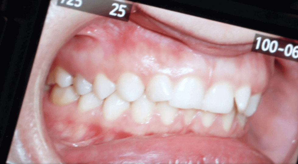 Фотография скученности зубов передается в лаборатория для последующего изготовления элайнеров