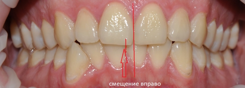 У пациента наблюдается смещение средних линий за счет нижней челюсти вправо. Нижняя челюсть сужена