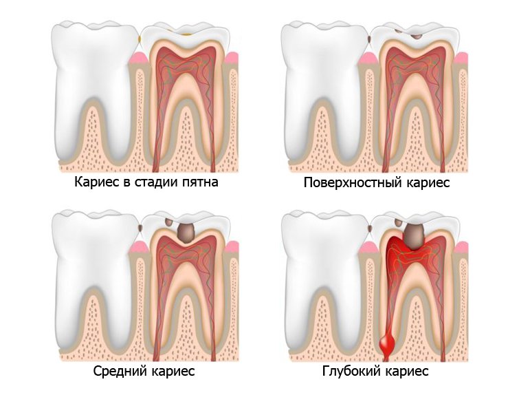 Как происходит разрушение зуба при глубоком кариесе