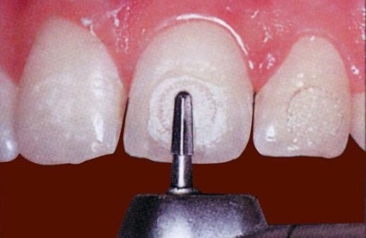брекет истончает эмаль зубов. Это миф