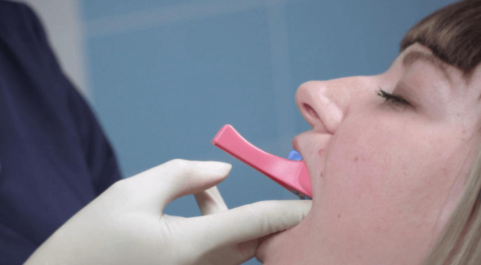 Процесс снятия слепков зубов для изготовления элайнеров