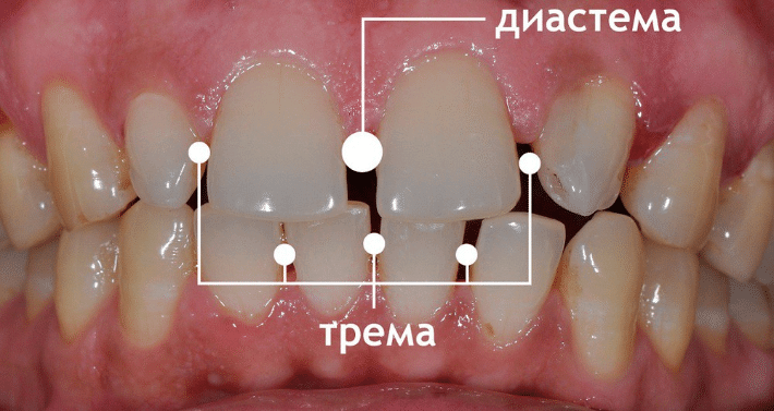lechenie tremy zubov3